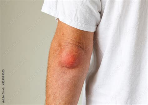 Man swelling erythematous lump pain elbow from Olecranon bursitis, student elbow medical ...