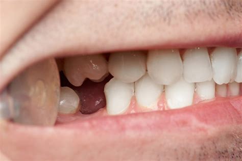 The Causes of Tooth Loss and How to Avoid It » Trending Us