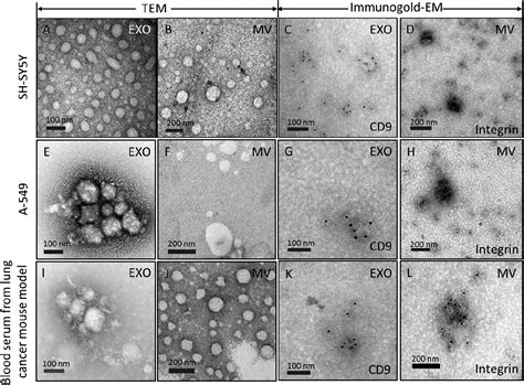 Direct detection of tumor-derived extracellular vesicles by self-assembly gold nanoisland-LSPR ...
