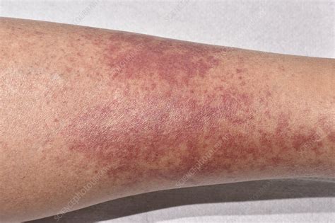 Allergic Vasculitis Rash