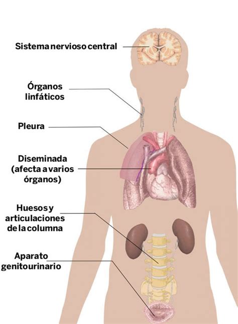 Tuberculosis extra pulmonar, un mal discreto y peligroso