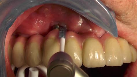 Debridement of a dental implant with LABRIDA BioClean - YouTube