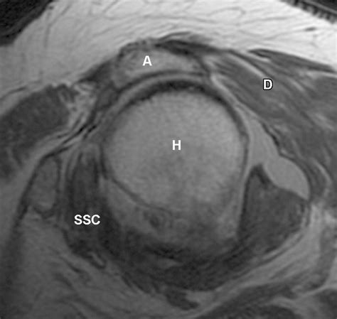 MR Imaging of Rotator Cuff Injury: What the Clinician Needs to Know ...