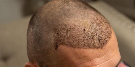 Turkey Hair Transplant Istanbul | Asli Tarcan Clinic
