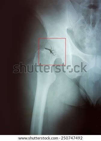 Hip Fracture Stock Images, Royalty-Free Images & Vectors | Shutterstock