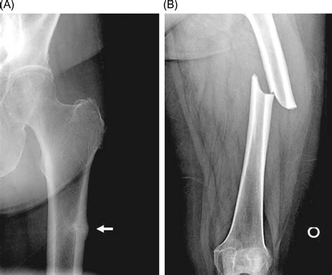 Bisphosphonates pharmacology and use in the treatment of osteoporosis | Oncohema Key