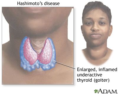 Hashimoto's disease (chronic thyroiditis): MedlinePlus Medical Encyclopedia Image