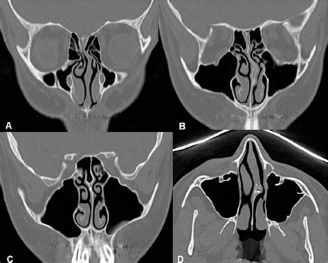 Nasal Septum Anatomy and Deviations: beyond straight and flat ...