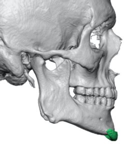 The Significance of the Antegonial Notch in Custom Jawline Implant Designs - Explore Plastic Surgery