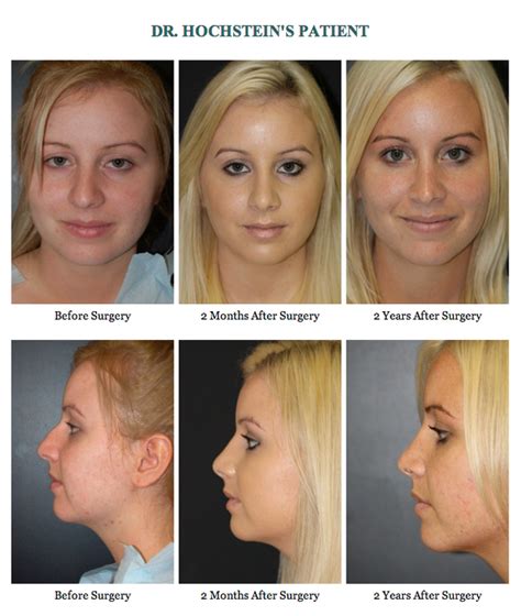 nose job recovery timeline - Loudly Diary Image Library