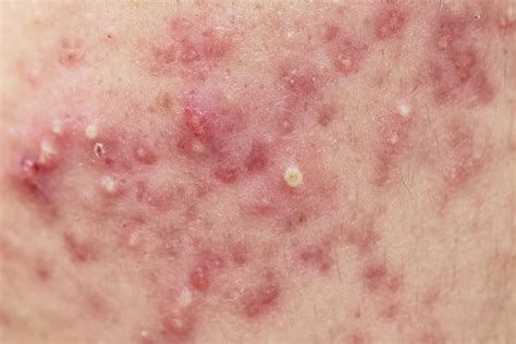 What Causes Acne And How Can I Get Rid Of It?