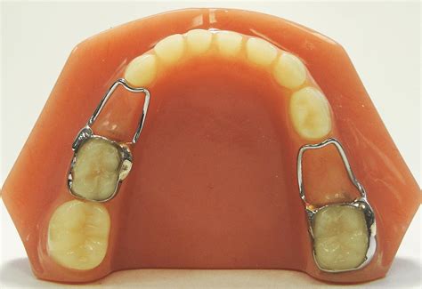 Space maintainers are a dental device used for children as they lose ...