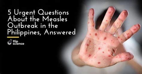 5 urgent questions about the Philippine measles outbreak, answered - FlipScience - Top ...