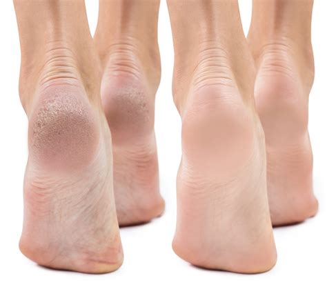 Dry Feet & Cracked Heels: Causes & Treatment - Foot and Ankle Group