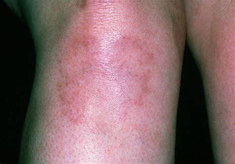 Systemic Lupus Erythematosus Rash On Woman's Leg Photograph by Dr P ...