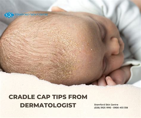 Cradle cap tips from Dermatologist - Stamford Skin Centre