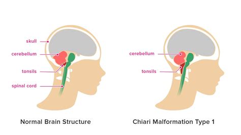 Chiari Malformation: Symptoms, Causes, and More