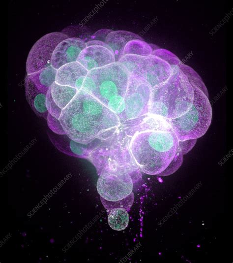 Colon cancer cells, fluorescence micrograph - Stock Image - C038/3156 ...