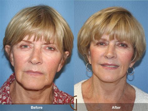 Before & After Facelift 55 | Facelift, Mini