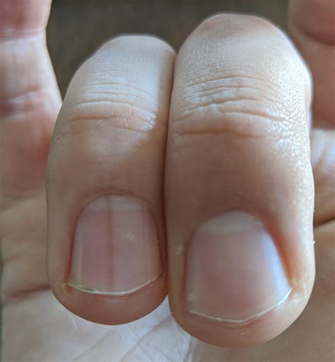 Update 119+ drugs causing nail pigmentation - ceg.edu.vn