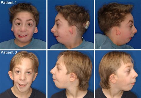 "Mandibulofacial dysostosis with microcephaly" caused by EFTUD2 mutations: expanding the ...