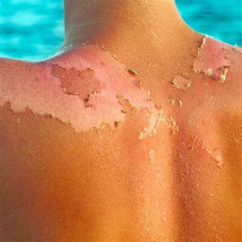 Sunburn Peeling - How to Stop Sunburn Peeling Fast and Safely