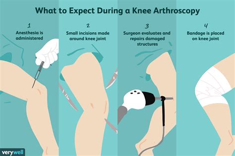 Risks and Complications of Knee Arthroscopy Surgery