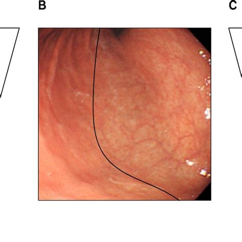 Kimura-Takemoto classification of chronic atrophic gastirits: (A)... | Download Scientific Diagram