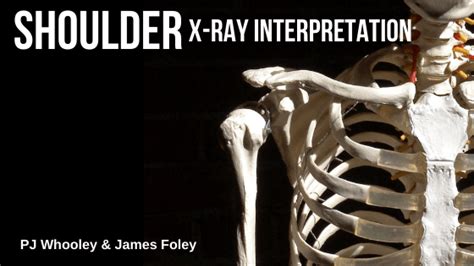 Shoulder x-ray interpretation