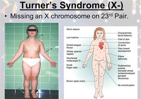 Turner Syndrome - Causes, Symptoms, Life Expectancy, Treatment