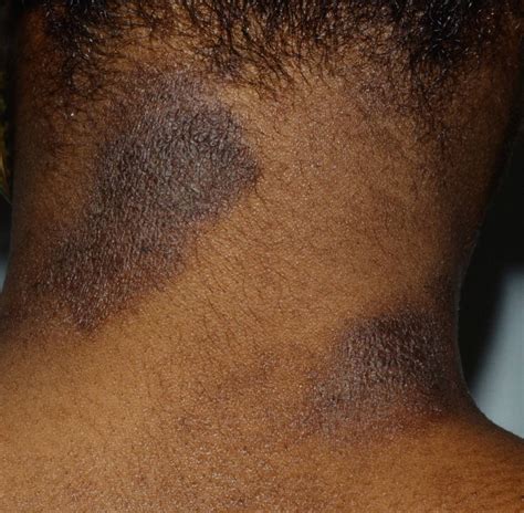10 éruptions cutanées les plus courantes sur la peau noire | Alai