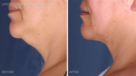 Neck Lift Alternatives: Surgical & Non-surgical Options | Omaha Cosmetic Center