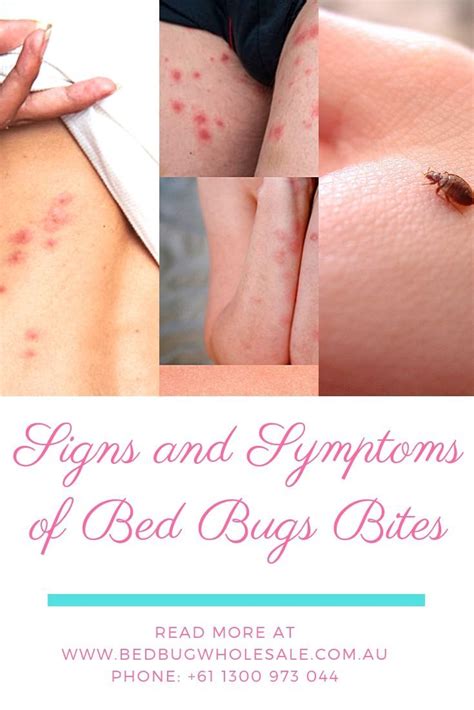 Signs and Symptoms of Bed Bugs Bites | Bed bug bites, Bed bugs, Bed bug facts