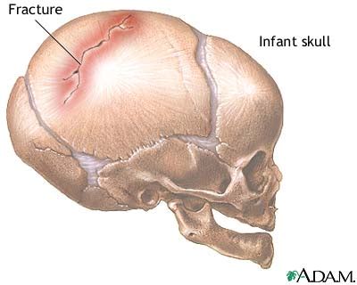 Infant skull fracture: MedlinePlus Medical Encyclopedia Image