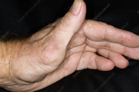 Thumb after surgery for dislocation - Stock Image - C006/9196 - Science Photo Library