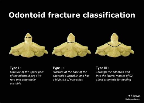 Odontoid fracture classification: diagram | Radiology Case | Radiopaedia.org | Radiology ...