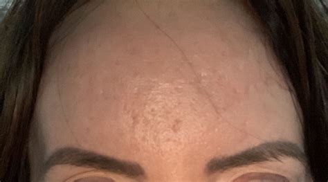 Forehead acne scars – Scar treatments – Acne.org Forum