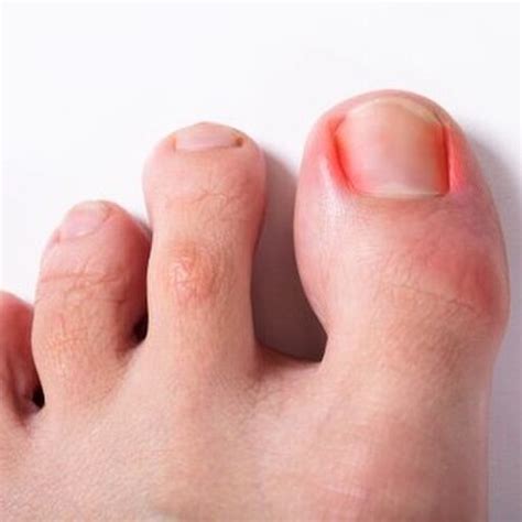 Ingrown Toenails | The Foot Place