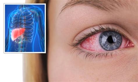 Fatty liver disease: Bloodshot and yellow eyes are warning signs - Fyne Fettle