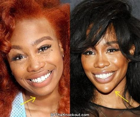 SZA Plastic Surgery Comparison Photos