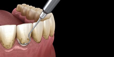 Scaling and Root Planing - Miami, FL - Periodontist