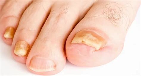 What Causes Yellow Toenail Fungus? How to Get Rid of It?