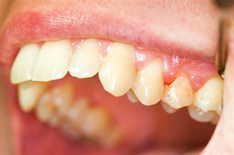 Periodontal Disease: Causes, Symptoms and Treatments