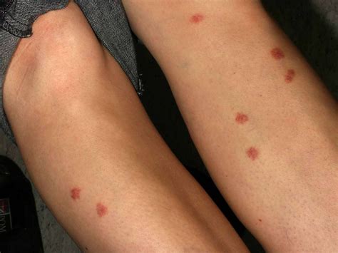 Types of Bug Bites: Symptoms and Treatments