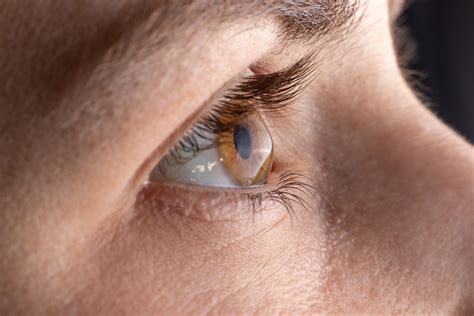 10 Common Questions About Keratoconus - KE - Eye Centers of Texas