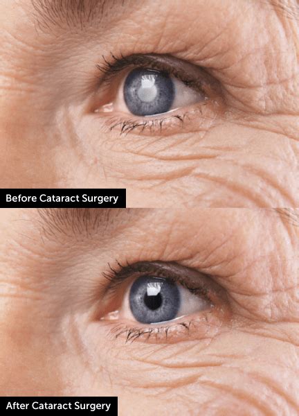 Tottenham: [View 27+] Glasses For One Eye After Cataract Surgery