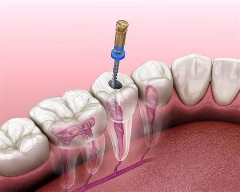 Todo lo que necesitas saber sobre las endodoncias - OdontoVida