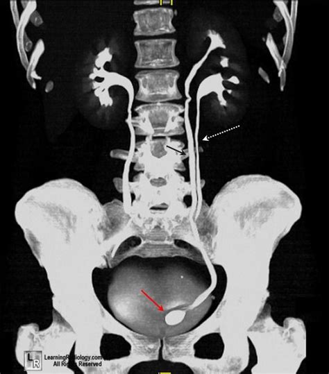 ureterocele - radiological exam | Radiology, X ray, Thoracic