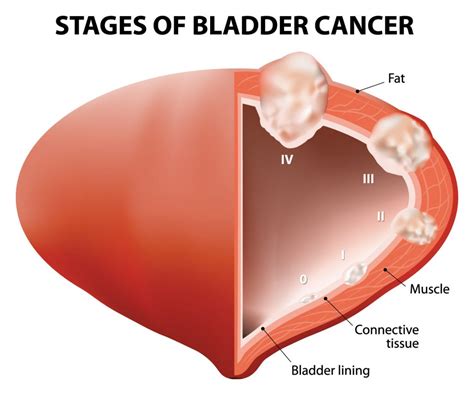 Bladder Cancer Diagram