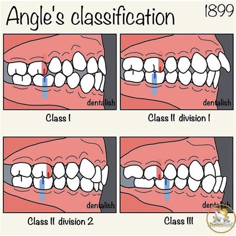 Which malloclusion is this? Can someone elaborate. : r/braces